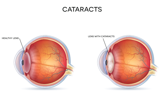 Cataracts diagram Cataracts diagram