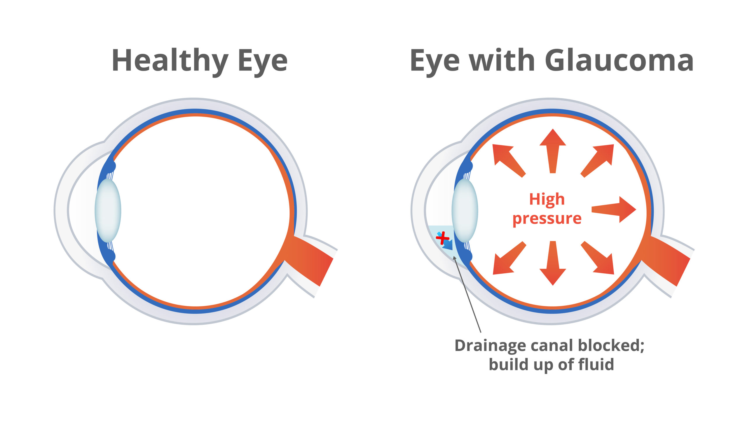 Vector illustration of a damaged eye with glaucoma and normal healthy eye isolated. High pressure in the eye damages optic nerves, drainage canal blocked, aqueous humor fluid is build up in the eye. Vector illustration of a damaged eye with glaucoma and normal healthy eye isolated. High pressure in the eye damages optic nerves, drainage canal blocked, aqueous humor fluid is build up in the eye.